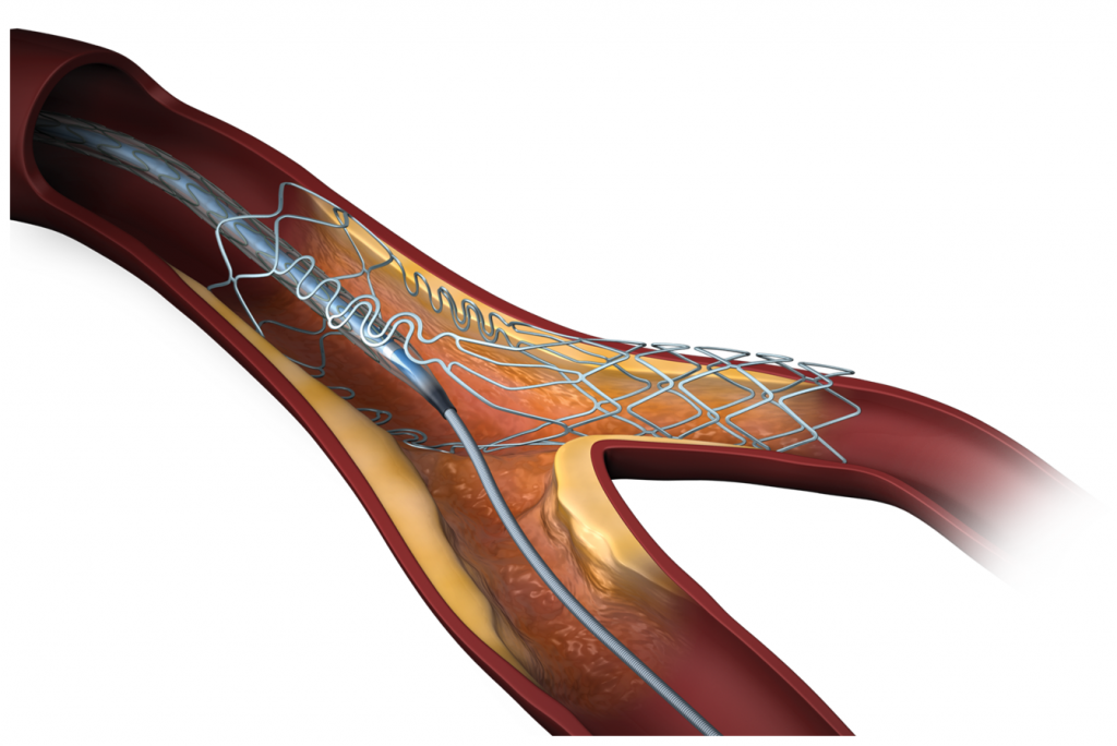 Как выглядит стент в сердце фото